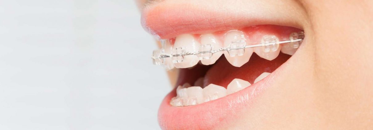 Aware of the cost of Invisalign providers – Factors to consider